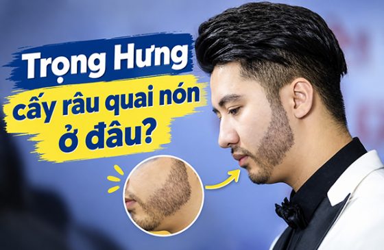 Trọng Hưng cấy râu quai nón ở đâu