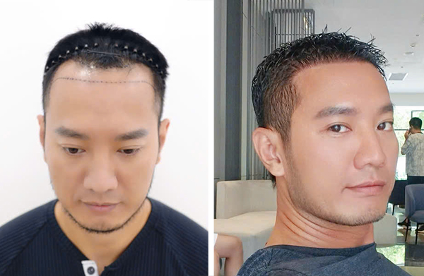 Youtuber Hùng Lâm cấy tóc sau 6 tháng