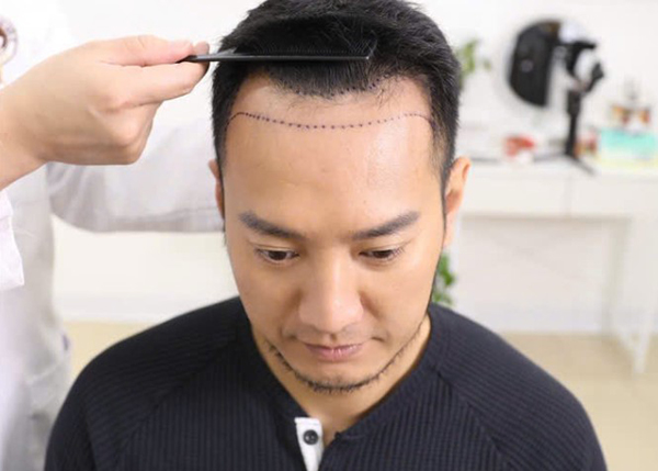 Youtuber Hùng Lâm trước khi cấy tóc
