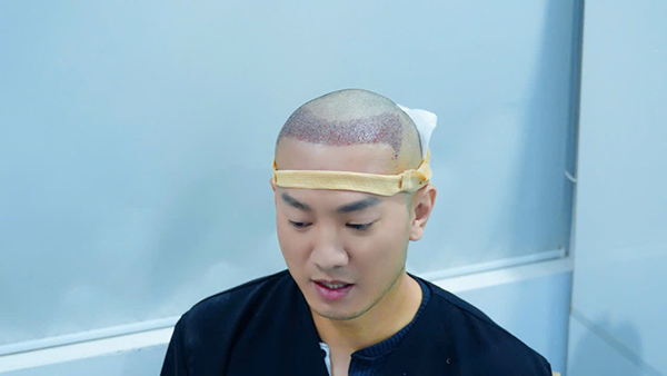 Youtuber Hùng Lâm ngay sau khi cấy tóc