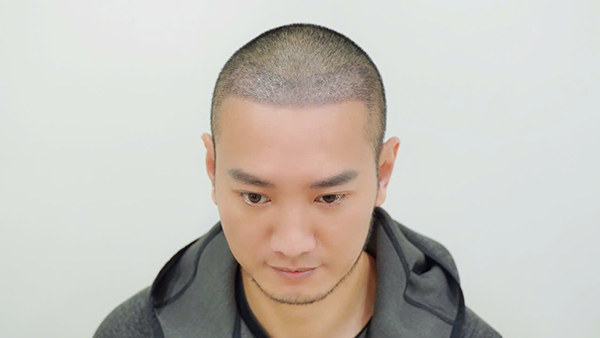 Youtuber Hùng Lâm sau 10 ngày cấy tóc