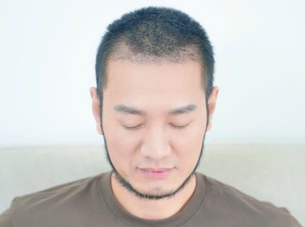 Youtuber Hùng Lâm sau 3 tháng cấy tóc