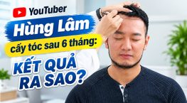 Youtuber Hùng Lâm cấy tóc sau 6 tháng: Kết quả ra sao?