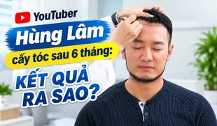 Youtuber Hùng Lâm cấy tóc sau 6 tháng: Kết quả ra sao?