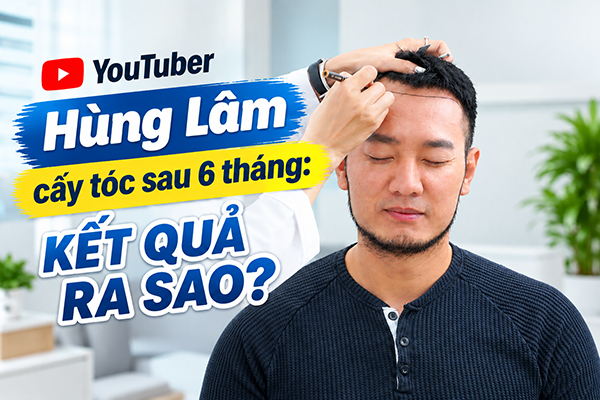 Youtuber Hùng Lâm cấy tóc sau 6 tháng