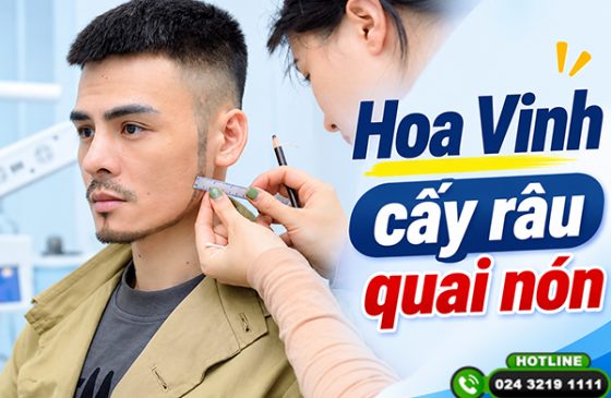 Hoa Vinh cấy râu quai nón: Hành trình thay đổi diện mạo nam tính