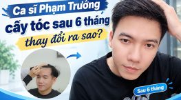 Ca sĩ Phạm Trưởng cấy tóc sau 6 tháng: Kết quả ra sao?