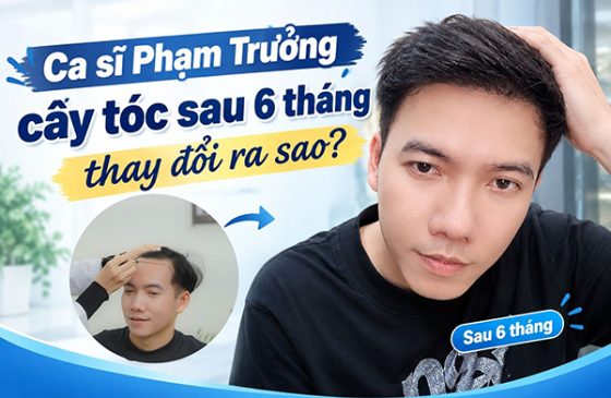ca sĩ pham trưởng cấy tóc sau 6 tháng thay đổi ra sao