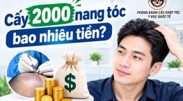 Cấy 2000 nang tóc bao nhiêu tiền? Bảng giá FUE, HAT, PNS