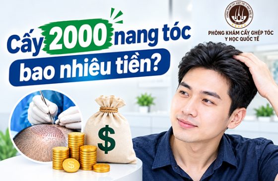 Cấy 2000 nang tóc bao nhiêu tiền