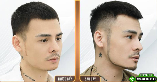 cấy râu nam
