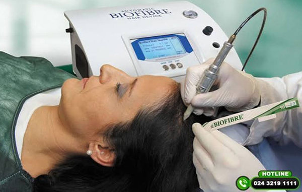 cấy tóc sinh học