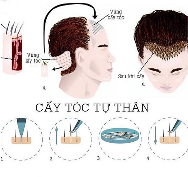 cấy tóc tự thân