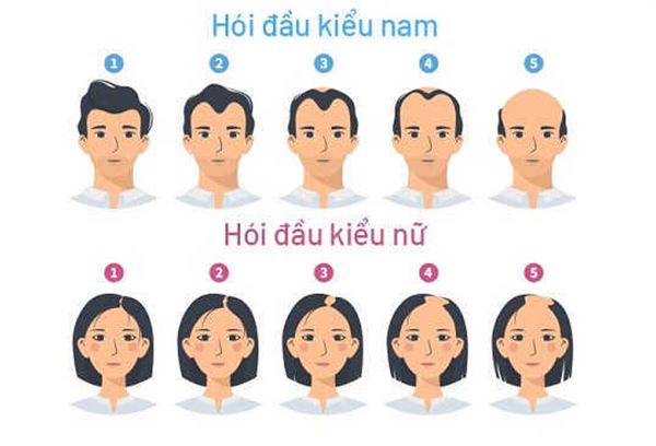 Rụng tóc DHT là gì? Nguyên nhân, dấu hiệu và giải